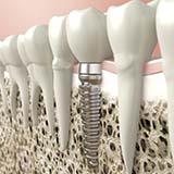 Dental Implant