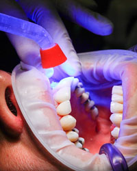 Dental Implant